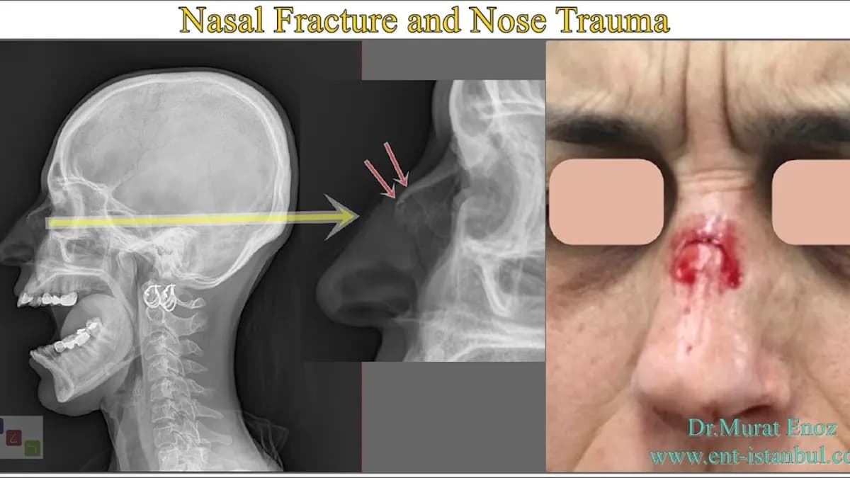 Gamrot affronte Salkill malgré une fracture au nez : une détermination sans faille Gamrot affronte Salkill malgré une fracture au nez : une détermination sans faille