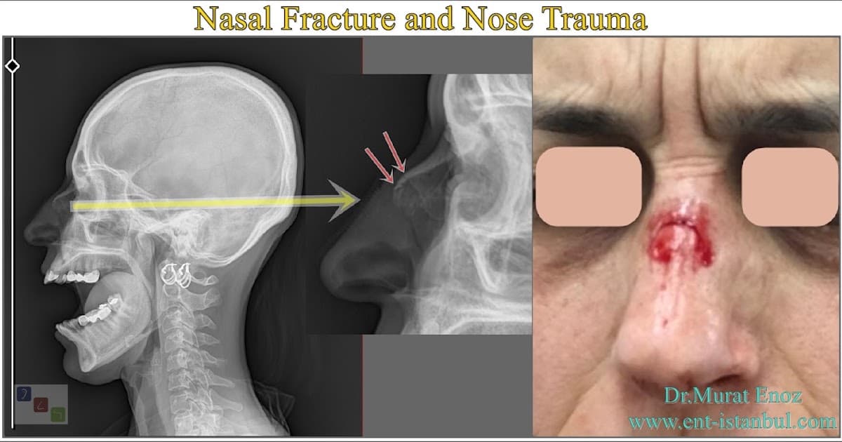 Gamrot vs Salkill : Le Combat qui a tout changé après une fracture au nez Gamrot vs Salkill : Le Combat qui a tout changé après une fracture au nez
